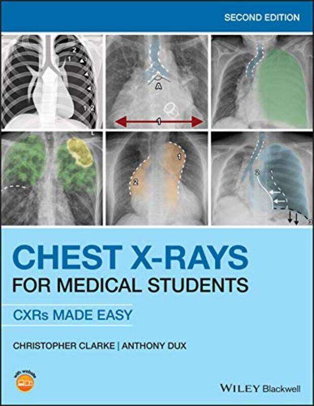 Chest XRays for Medical Students CXRs Made Easy by Clarke, Christopher (ST2 Clinical Radiology Trainee at Nottingham University Hospitals and Honorary
Chest XRays for Medical Students CXRs Made Easy by Clarke, Christopher (ST2 Clinical Radiology Trainee at Nottingham University Hospitals and Honorary