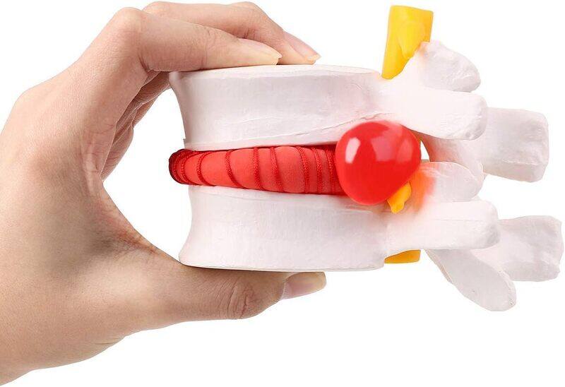 Yovinn Human Anatomical Lumbar Disc Herniation Model - Lumbar Spine Model for Teaching & Learning - Excellent Way for Demonstrating Disc
Yovinn Human Anatomical Lumbar Disc Herniation Model - Lumbar Spine Model for Teaching & Learning - Excellent Way for Demonstrating Disc