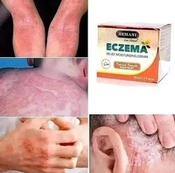 Eczema Cream is a 100% Natural & Halaal 50 ml