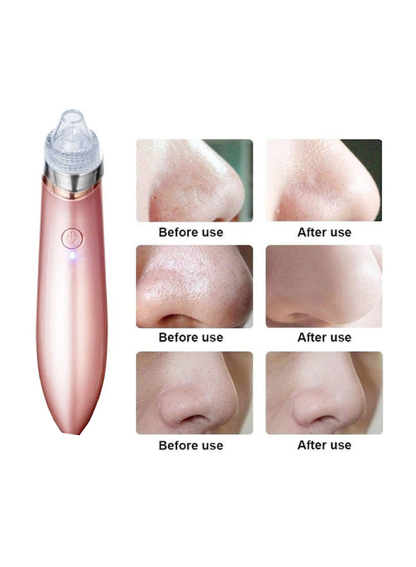 Gennext Blackhead Remover Vacuum Suction Facial Pore Cleaner Kit with 4 Suction Head & 5 Different Suction Levels, Pink