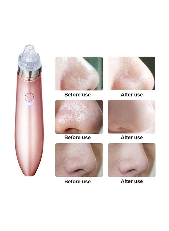 Gennext Blackhead Remover Vacuum Suction Facial Pore Cleaner Kit with 4 Suction Head & 5 Different Suction Levels, Pink