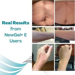 NewGel+E Advanced Silicone Gel for Scars, 15gm