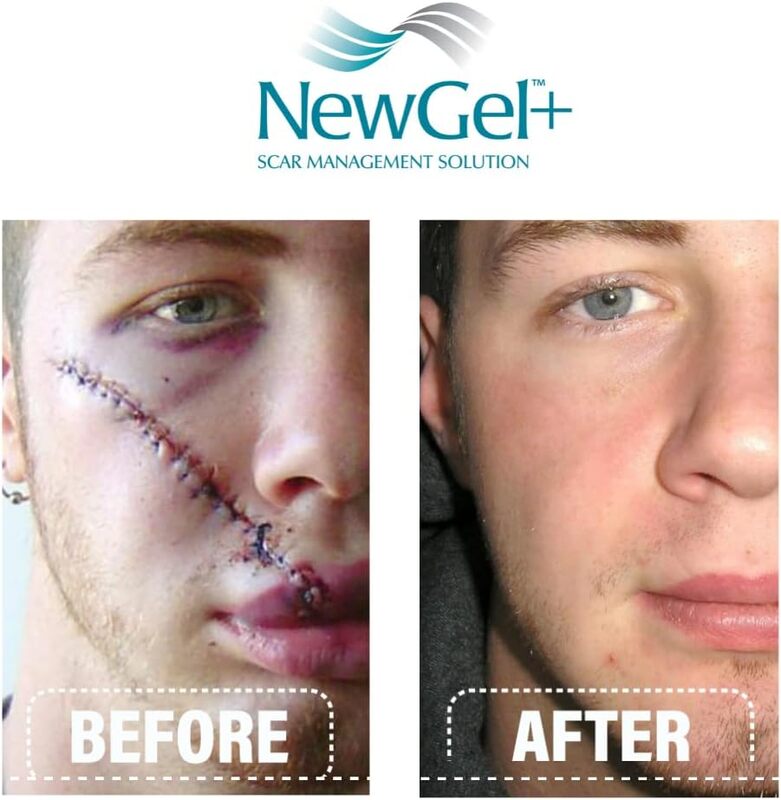 NewGel+E Advanced Silicone Gel for Scars, 15gm