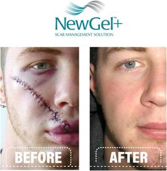 NewGel+E Advanced Silicone Gel for Scars, 15gm