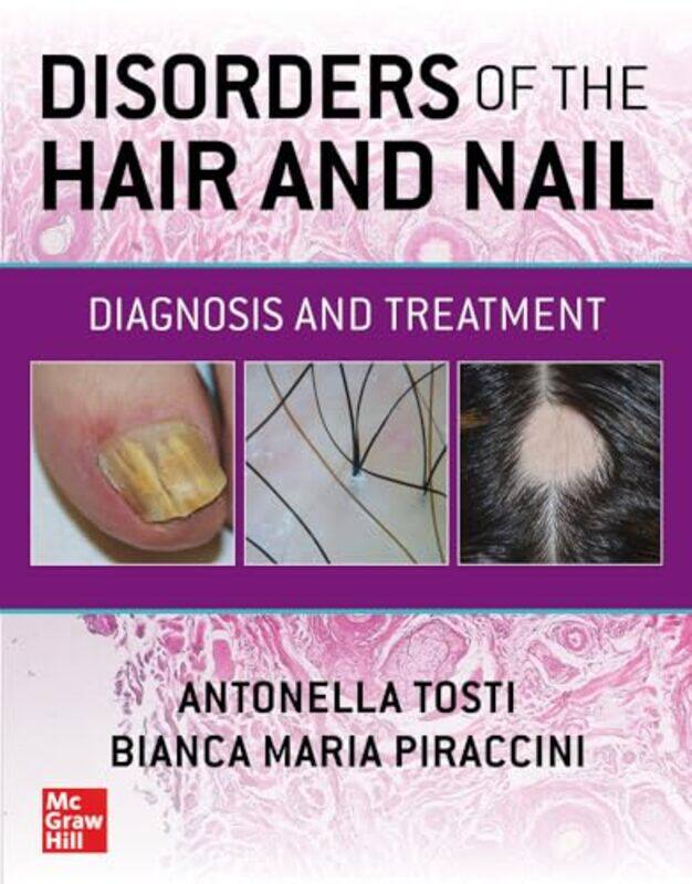 

Disorders of the Hair and Nail Diagnosis and Treatment by Kirsten AndersonWho HQAndrew Thomson-Paperback