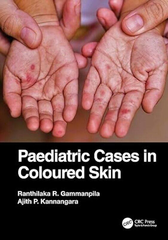 

Paediatric Cases in Coloured Skin by Ranthilaka R Teaching Hospital Kalutara, Sri Lanka GammanpilaAjith P Teaching Hospital Karapitiya, Sri Lanka Kann