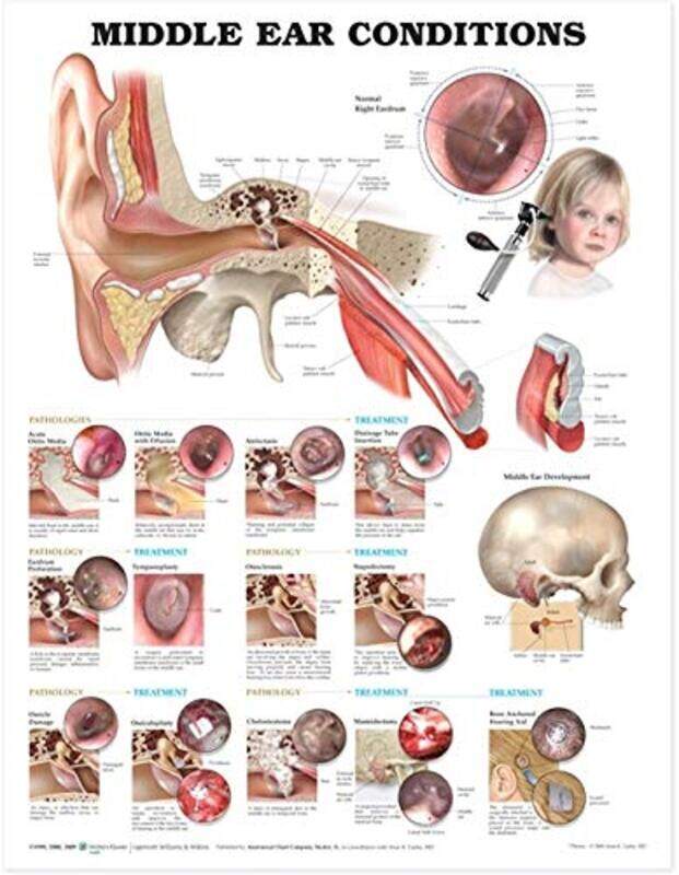 

Middle Ear Conditions Anatomical Chart by Anatomical Chart Company - Paperback