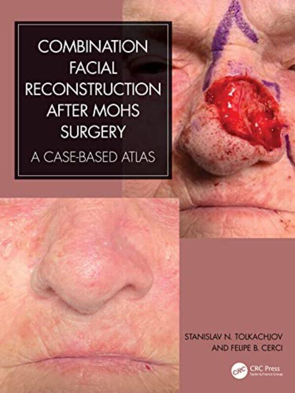 

Combination Facial Reconstruction after Mohs Surgery by Nerea Amoros ElorduyNikhilesh SinhaColin Marx-Hardcover