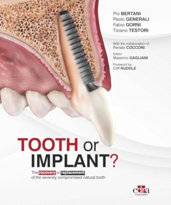 

Tooth Or Implant by Paolo GeneraliFabio GorniTiziano Testori-Hardcover