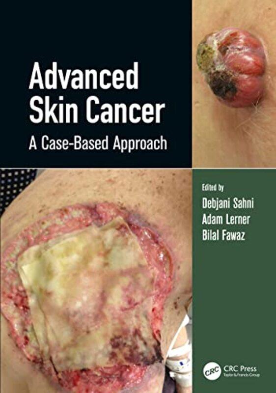 

Advanced Skin Cancer by Debjani SahniAdam Lerner-Hardcover