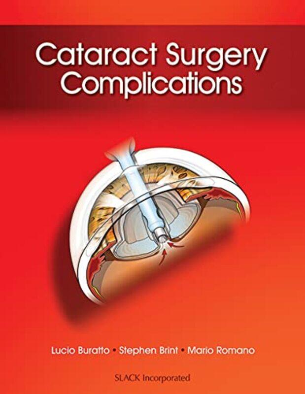 

Cataract Surgery Complications by David W Ivy Tech Community College USA Bennett-Hardcover